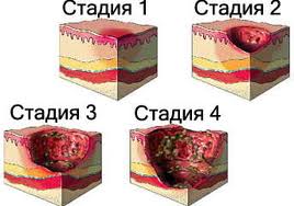 Процесс развития пролежней