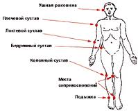 Места возникновения пролежней