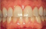 GINGIVITIS 